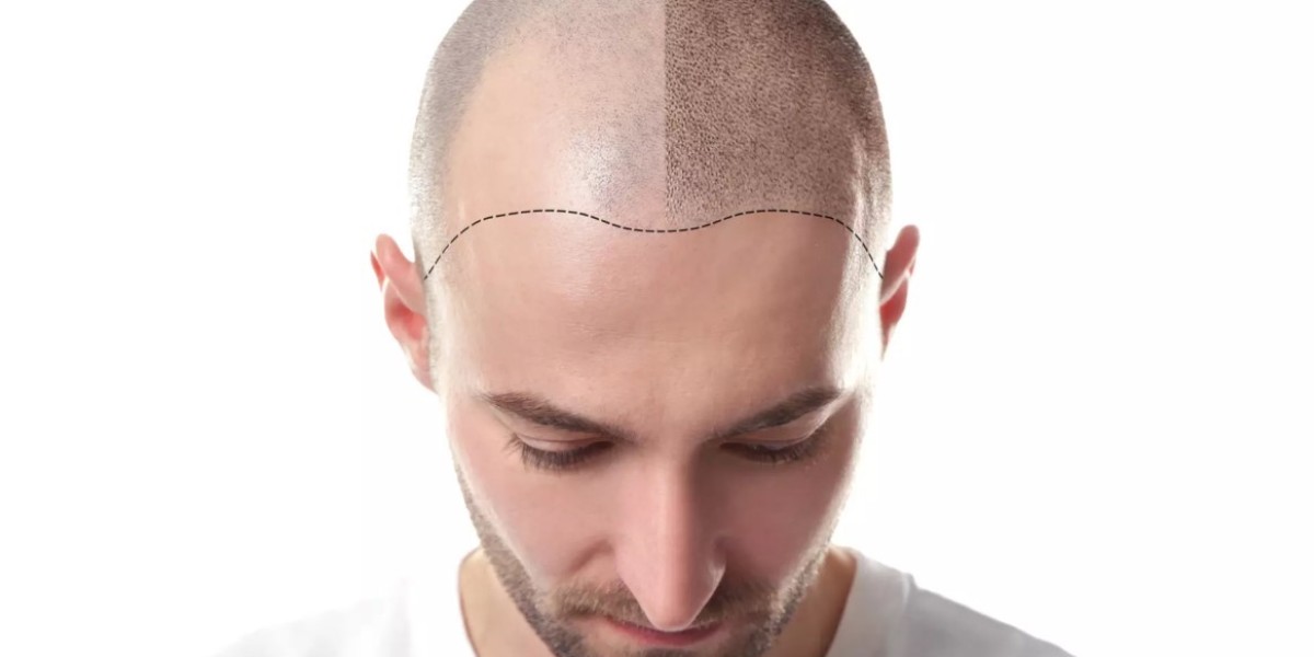 Is Stem Cell Hair Transplant Safe? Riyadh Specialists Weigh In