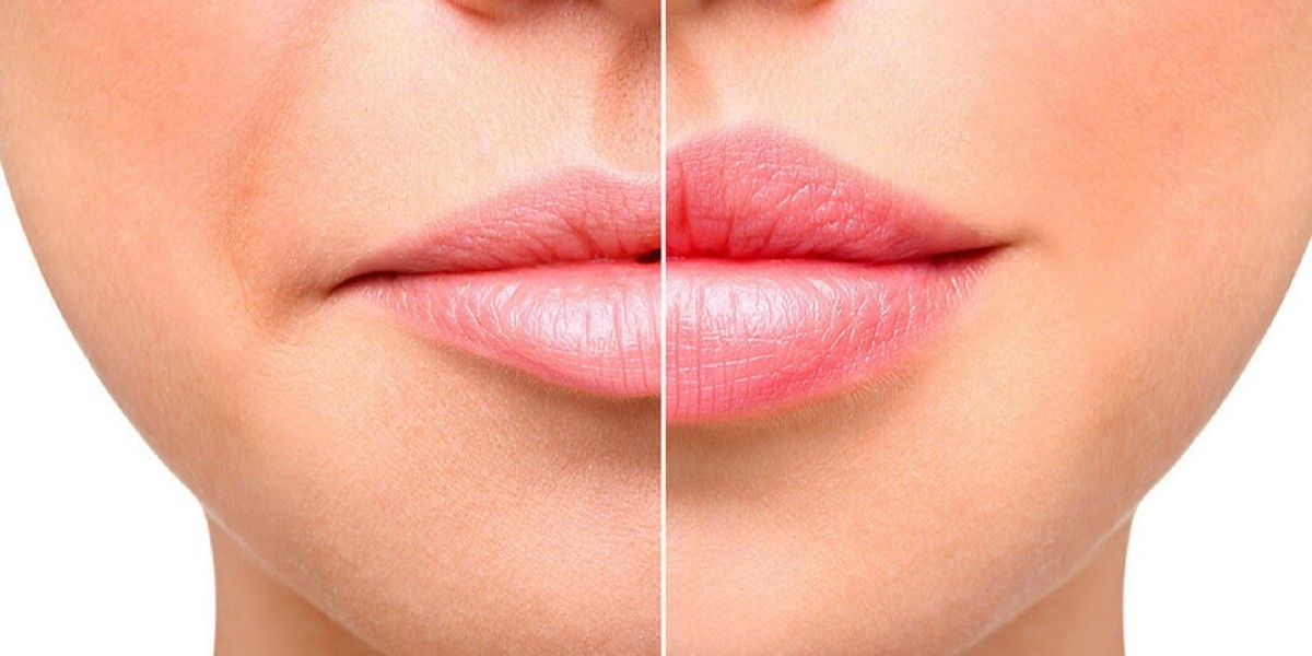 Riyadh’s Safest Clinics for Lip Injections