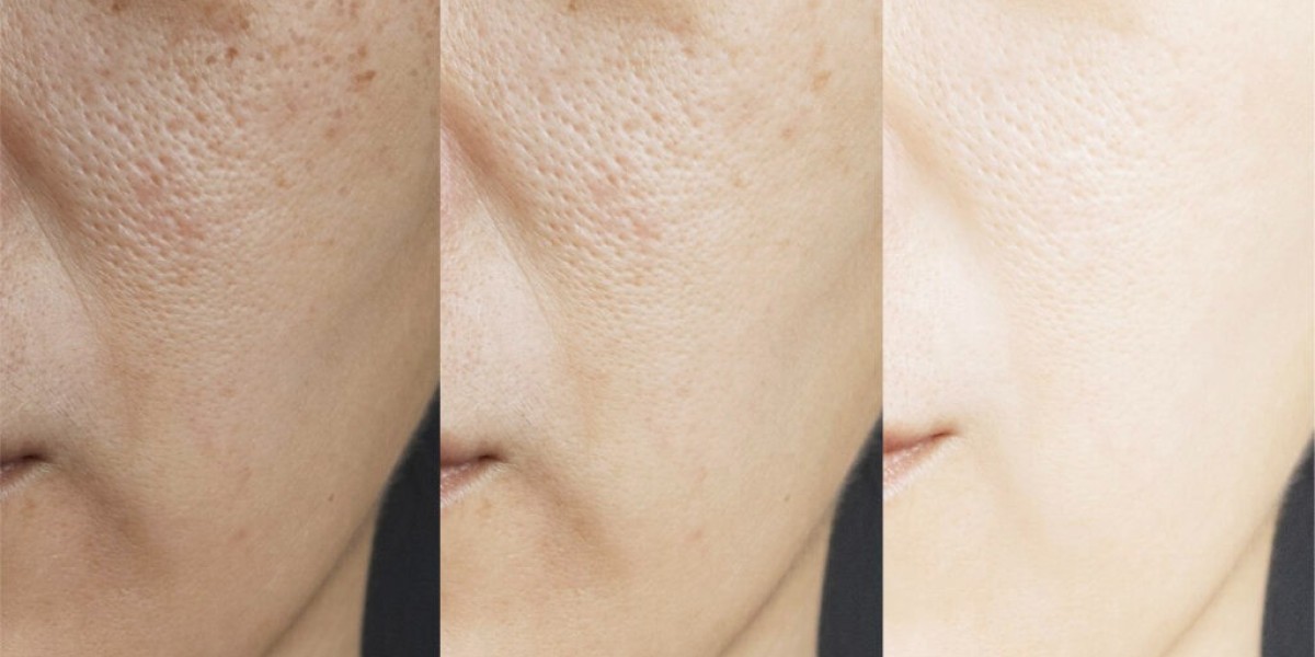 Transform Your Skin with Dr. Sin Yong's 4D Scar Reconstruction Expertise