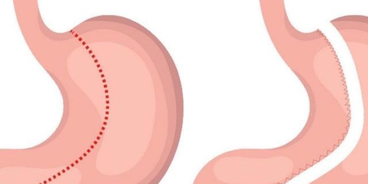 Pros and Cons of Gastric Sleeve Surgery in Riyadh