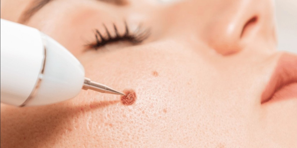 Client Reviews: Mole Removal in Riyadh Clinics