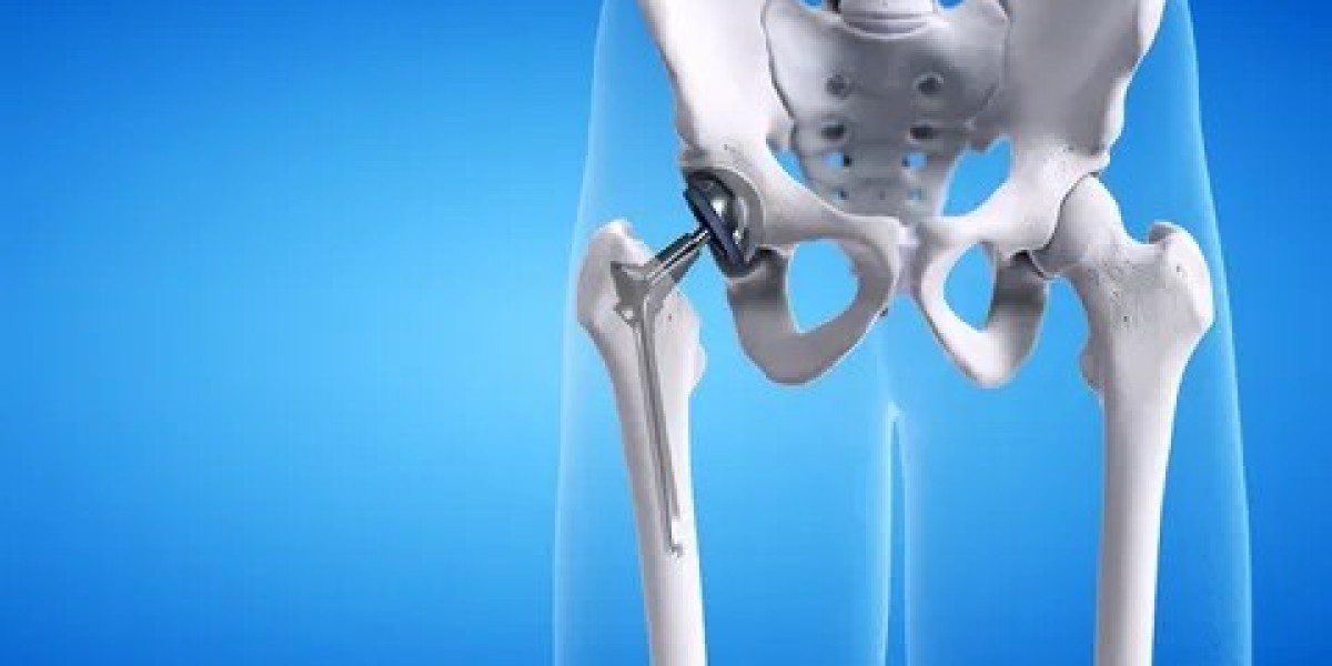 Hip Replacement in Islamabad vs. Lahore: Which is Better?