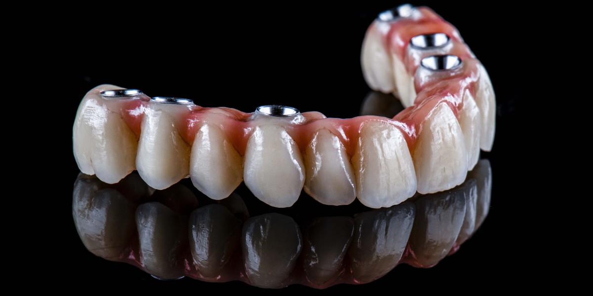 Are Full Mouth Implants Permanent?