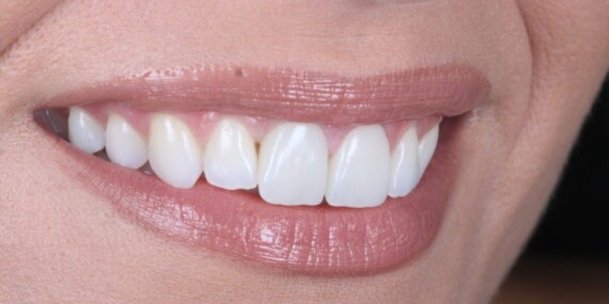COMBINATION OF WHITENING TECHNIQUES FOR THE SUPER END RESULT