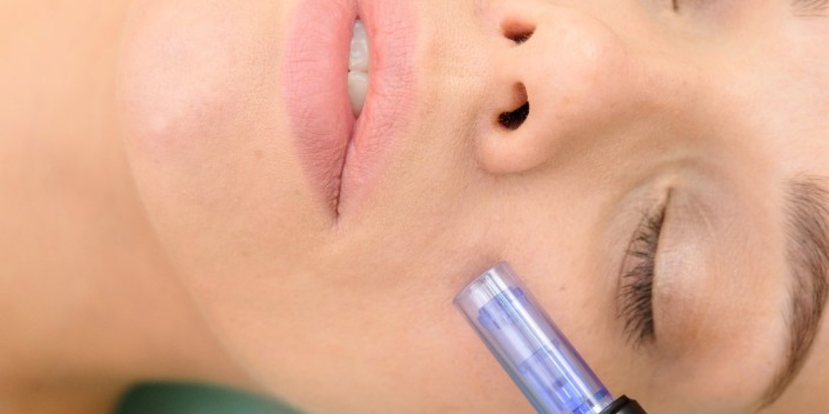Say Goodbye to Scars: Understanding Acne Scars and the Best Treatments for a Smooth Face