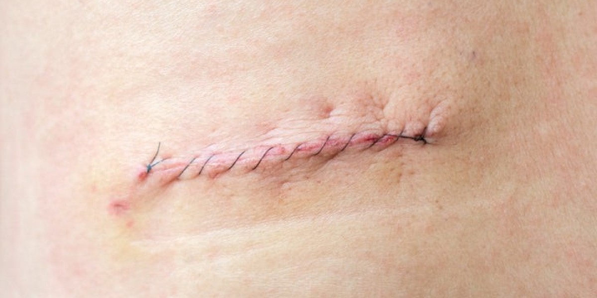 How Long Does It Take to Heal After Removing Stitches?