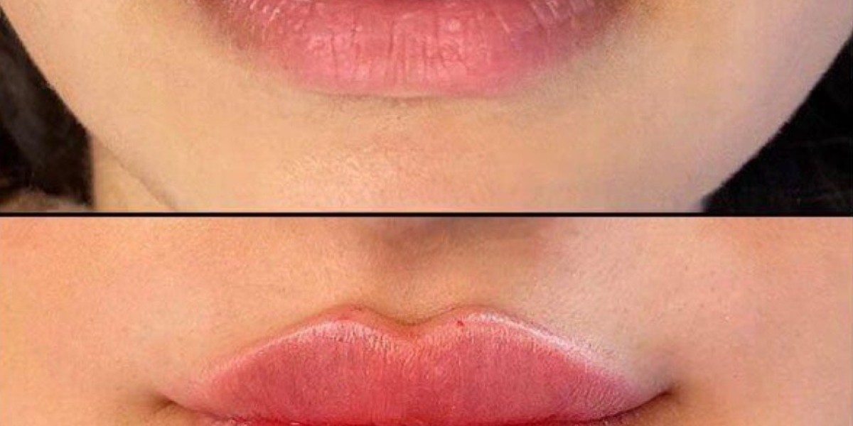 Perfectly Sculpted Lips with Russian Fillers in Riyadh