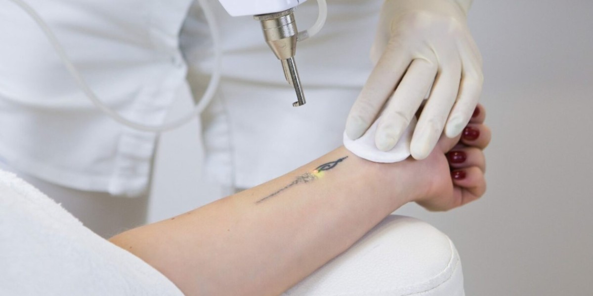 Laser vs. Other Tattoo Removal Methods: What Riyadh Offers