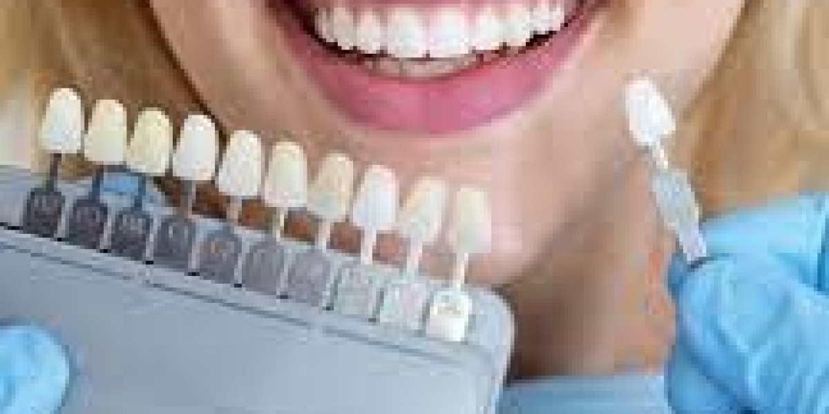 Cost of Dental Veneers: Tips for Finding Affordable Options