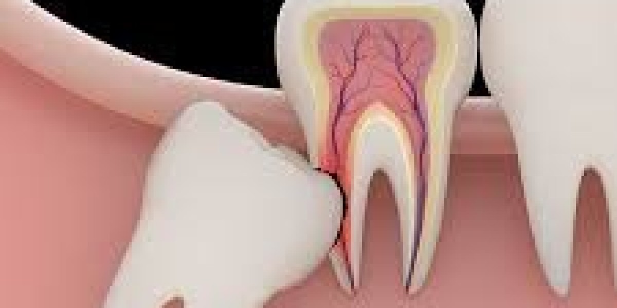 When to Avoid Tooth Extraction in Dubai: Choosing the Healthiest Smile