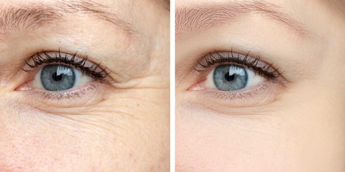 Latest Anti-Wrinkle Technology in Riyadh Clinics