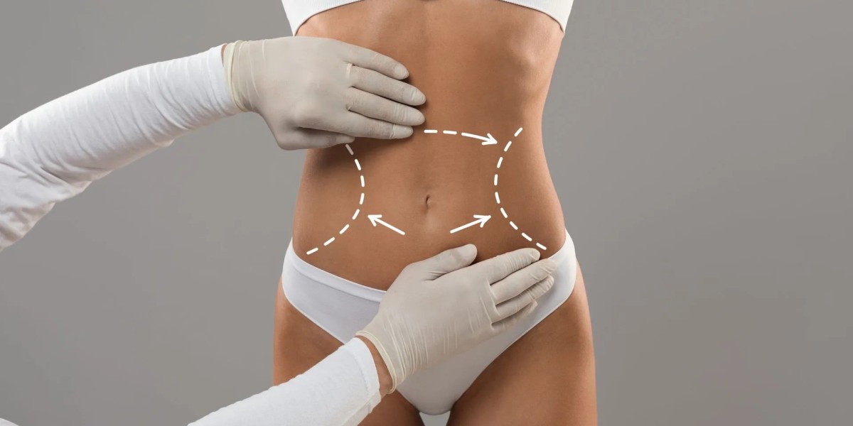 Feel Great with Liposuction’s Life-Changing Effects