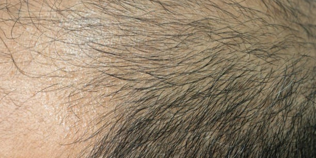 Top Solution for Hair Loss in Riyadh Revealed