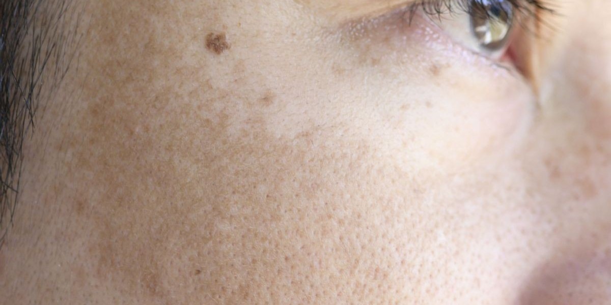 What You Should Know Before Starting Melasma Treatment