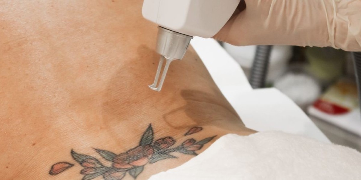 Trusted Experts in Fast, Clean Laser Tattoo Removal