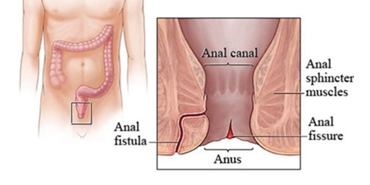 Effective Anal Fistula Treatment in Dubai: Everything You Need to Know