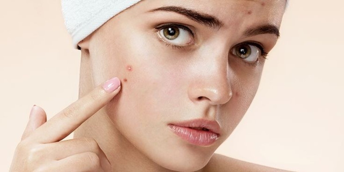 Microdermabrasion for Pimples: Is It Safe in Islamabad?