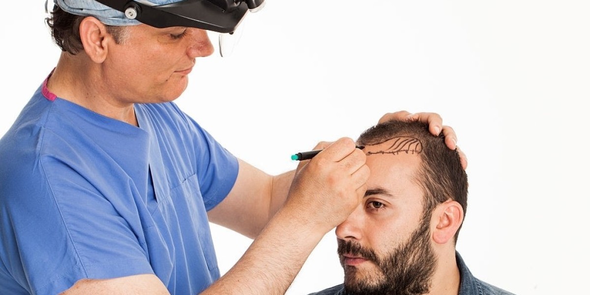 What is Hair Transplant? A Beginner’s Guide for Residents of Islamabad