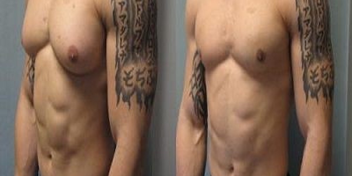 The Science Behind Gynecomastia Surgery and Its Growing Popularity in Dubai