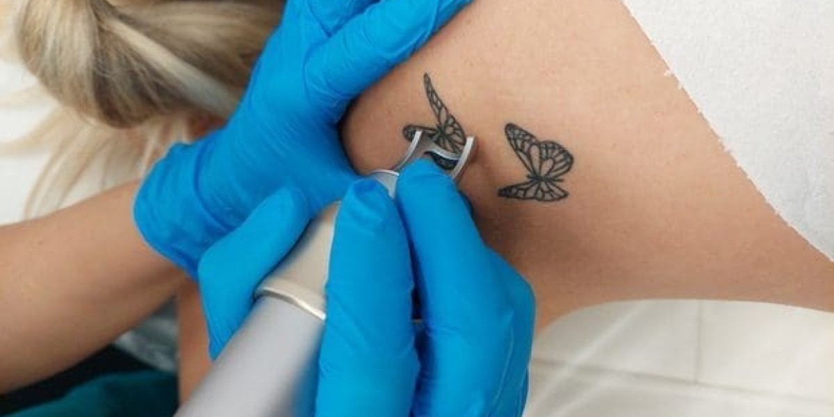The Principles of Picosure Laser Tattoo Removal Unveiled