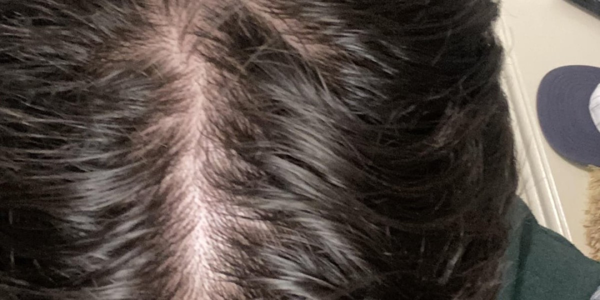 Does Saxenda Cause Hair Loss? What Are the Symptoms