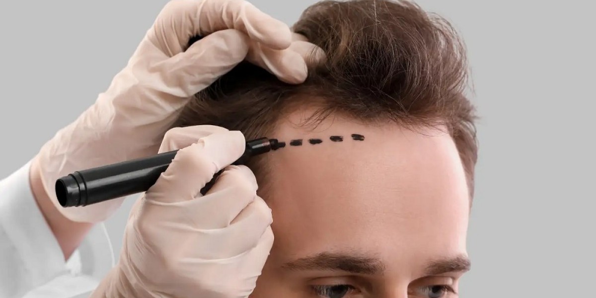 The Top Benefits of Getting a Hair Transplant in Islamabad