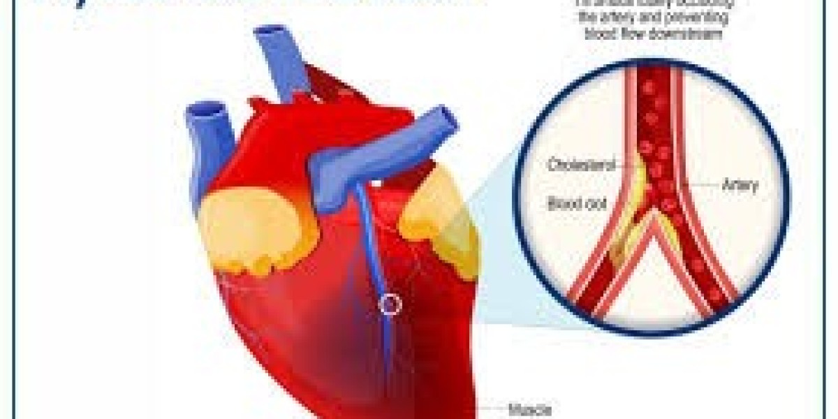 The Beating Challenge: How the Myocardial Infarction Market is Revolutionizing Heart Care