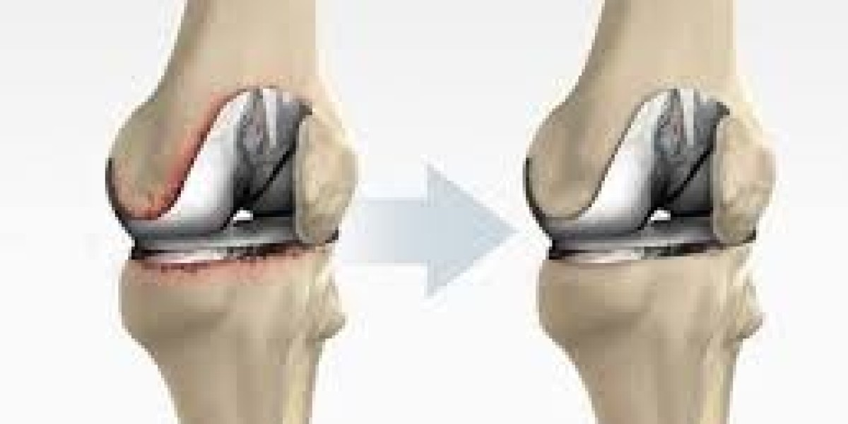Top Knee Replacement Causes: Why People Need Surgery