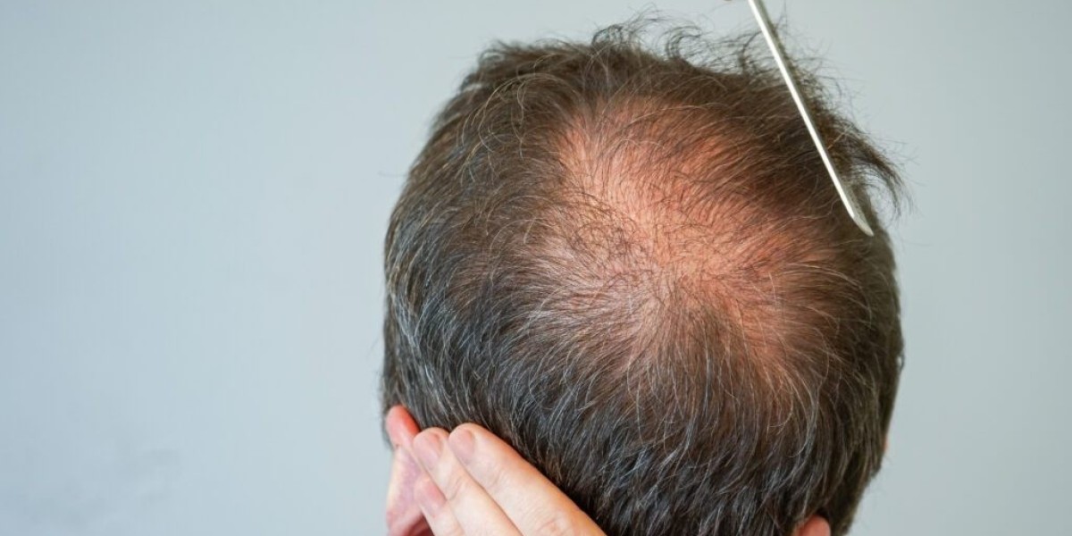 How Long Does It Take for Finasteride to Show Hair Growth Results