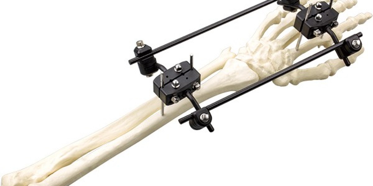 Bone Fixation Plates Market: The Role of 3D Printing in Orthopedic Advancements