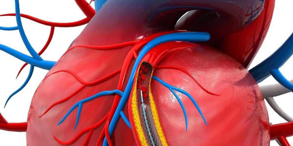 Angioplasty Balloons Market Scenario: Key Insights into Market Dynamics, Challenges, and Technological Innovations in He