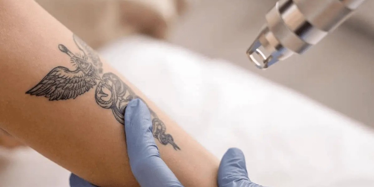 Smart Skin Solutions – The Science of Laser Tattoo Removal!