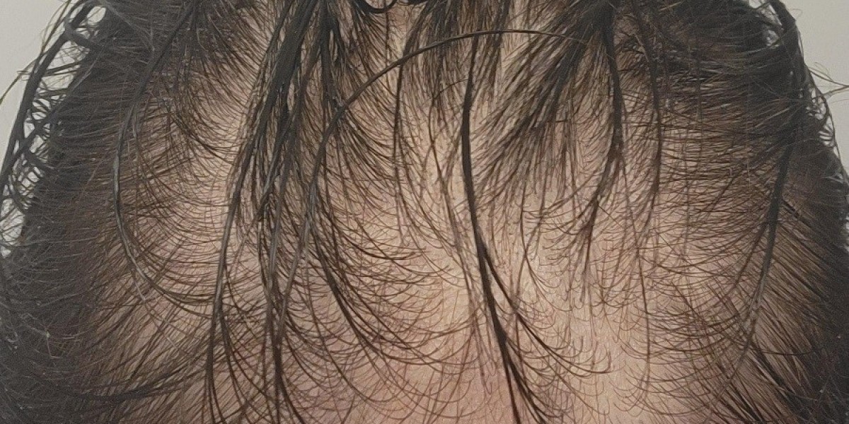 Does Saxenda Cause Hair Loss? What Users Report