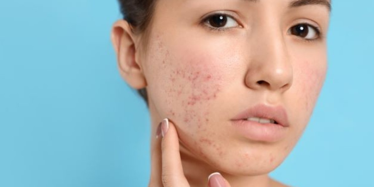 Why You Should See a Dermatologist for Acne