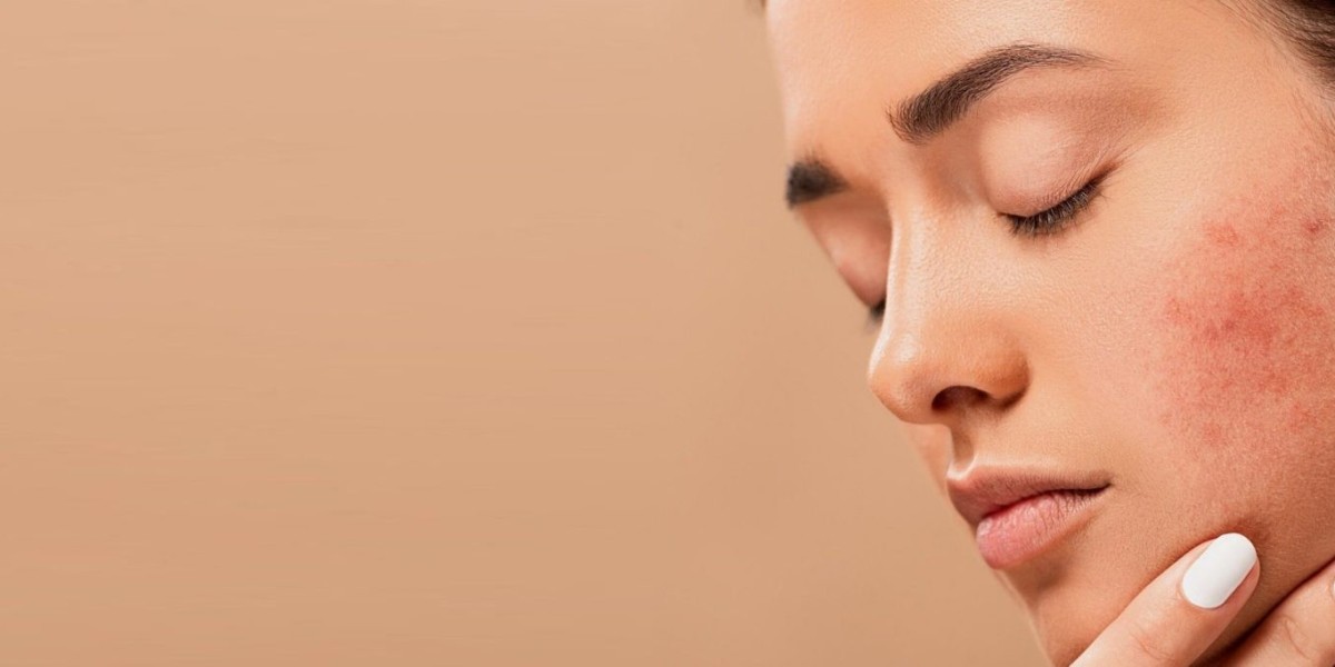 Adult Acne Solutions: Expert Care in Riyadh​