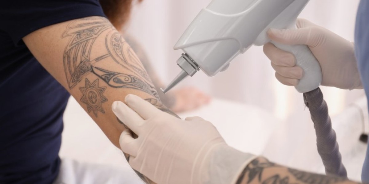 Pain Management for Laser Tattoo Removal
