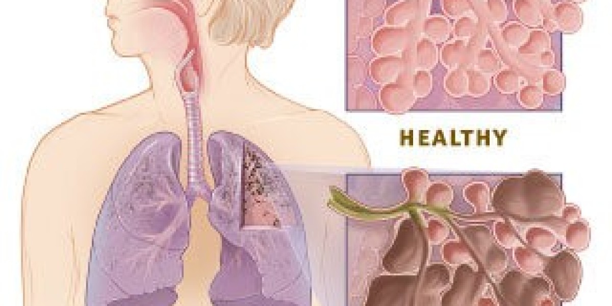 Understanding Chronic Obstructive Pulmonary Disease (COPD): Causes, Symptoms & Management