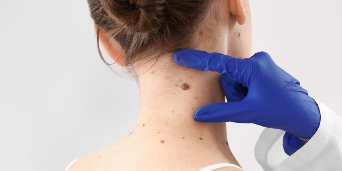 Hair Transplant Success Rates Explained