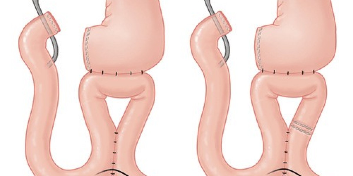 Anastomosis Devices Market: Key Trends, Innovations, and Growth Prospects