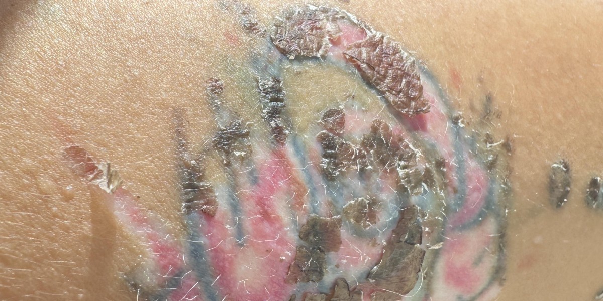 Heal Faster from Signs of Injury After Laser Tattoo Removal