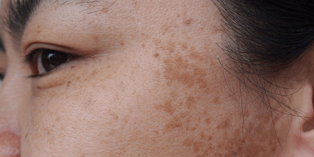 The Truth About Melasma: Can Treatment Fully Remove Dark Spots?