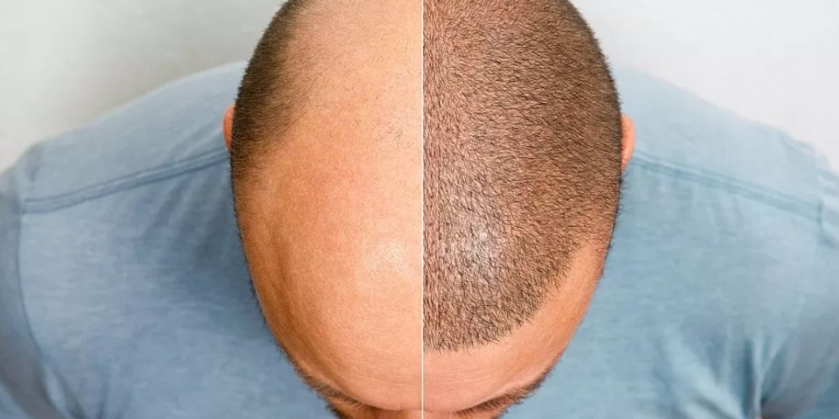Say Goodbye to Baldness with GFC Hair Transplant in Riyadh