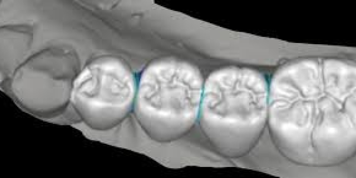 Dental Ceramic Market Growth: Key Factors Driving Global Demand