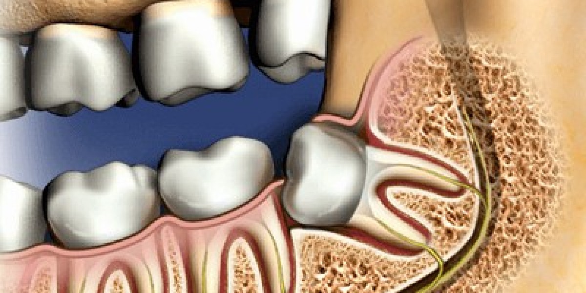 Top Reasons You Might Need a Tooth Extraction in Dubai