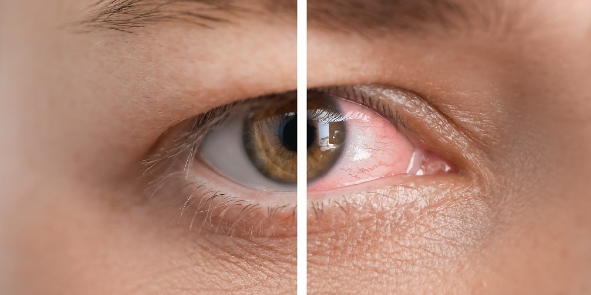 Implantable Collamer Lens Market Long-Term Outlook Driven by Innovation, Demand, and Expanding Global Access