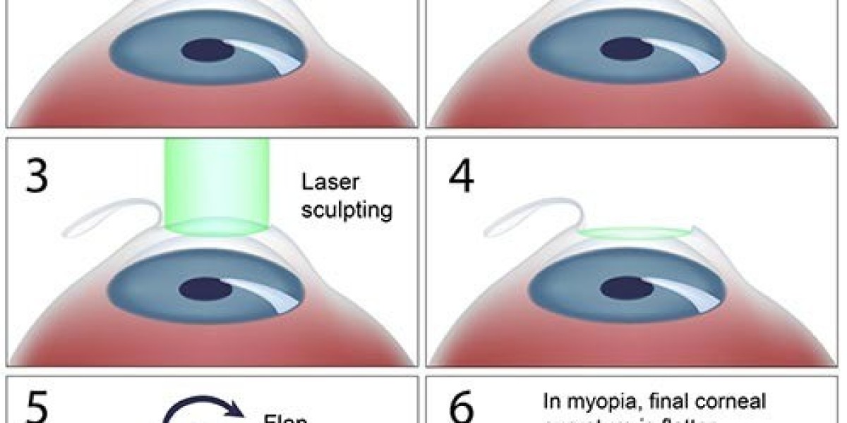 Advanced Laser Eye Surgery in Delhi for Clear Vision