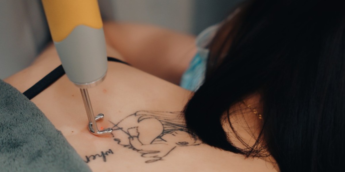 Remove Tattoos the Smart Way with Laser Tattoo Removal!