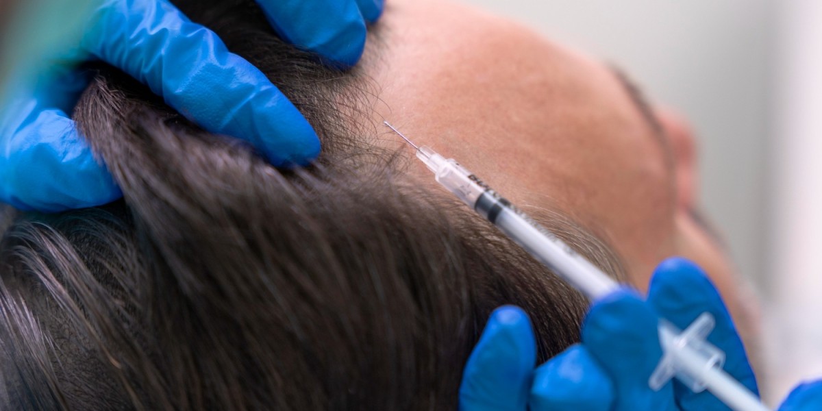 PRP Hair Treatment in Mississauga: Revitalize Your Hair Naturally at Eterna Health