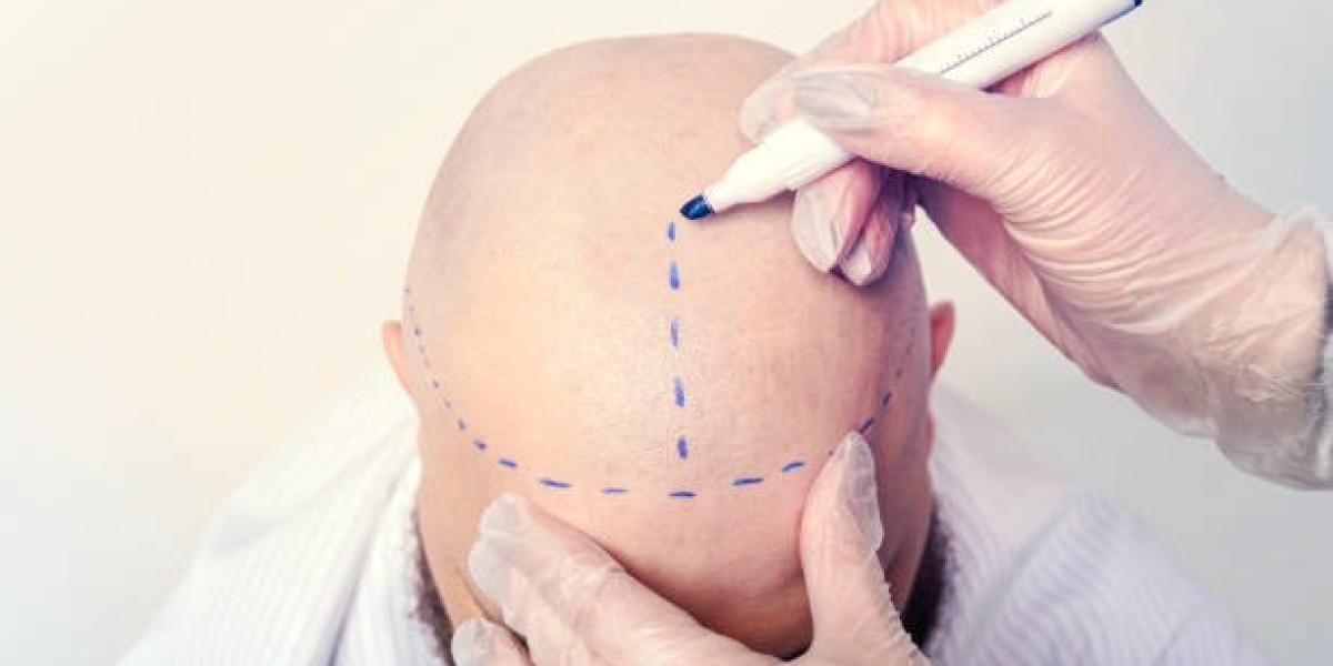 Top Questions About Hair Transplant in Riyadh