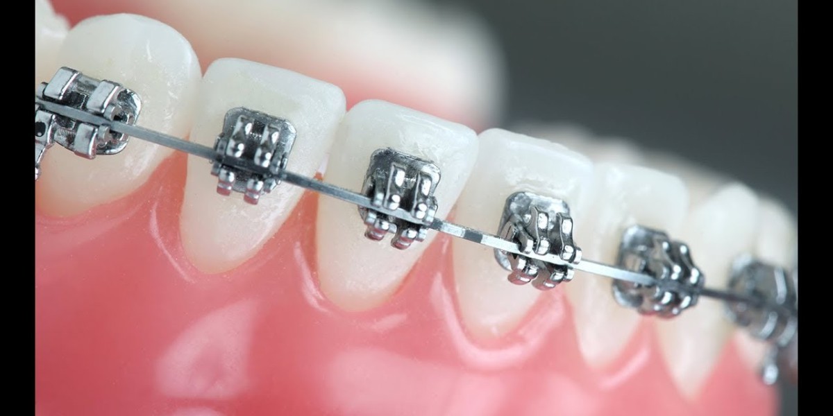 Orthodontic Supplies Market: Trends, Growth Drivers, and Future Outlook